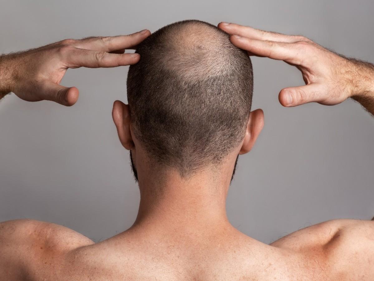 lalopecia androgenetica cause sintomi e trattamenti
